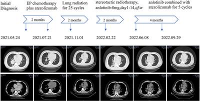 The surge of HBsAb level in a HBsAg-negative ES-SCLC patient after anlotinib plus atezolizumab treatment: A case report